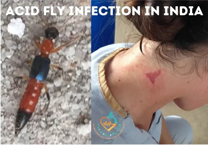 Acid fly or Nairobi fly infection